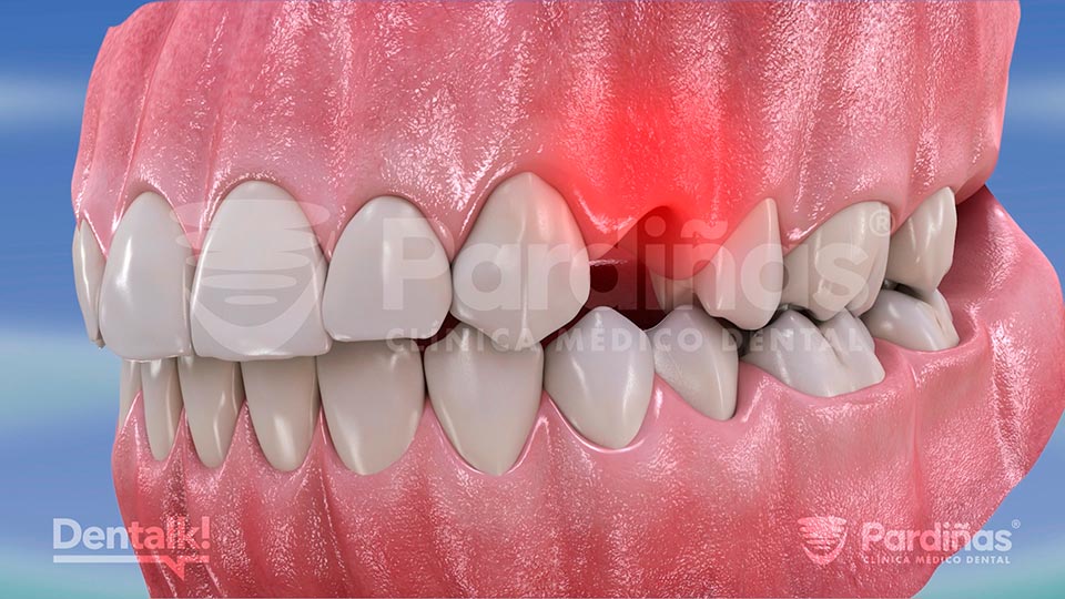 Dolor en la boca tras una extracción dental o exodoncia