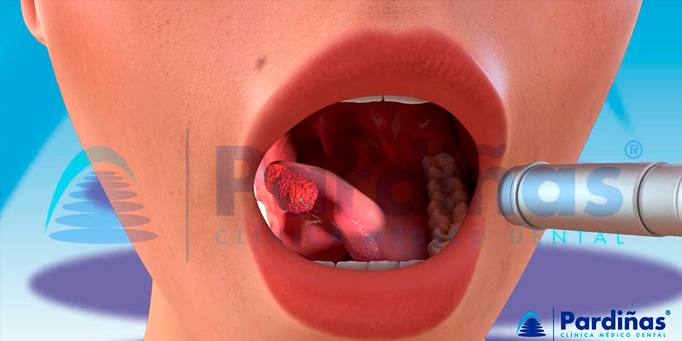 Cáncer oral - Aspecto de un tumor en la lengua