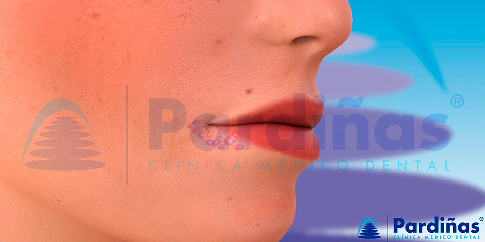 Aspecto de un herpes labial o calentura - Aftas herpetiformes